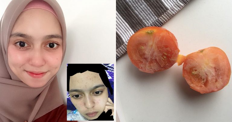 Hanya Guna Petua Tomato Beku, Kulit Berjerawat & Berparut Kembali Pulih, Pinkish Serta Glowing