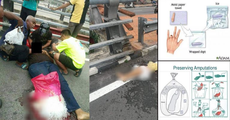 Apa Perlu Kita Buat Jika Berdepan Kemalangan Libatkan Anggota Badan Terputus?