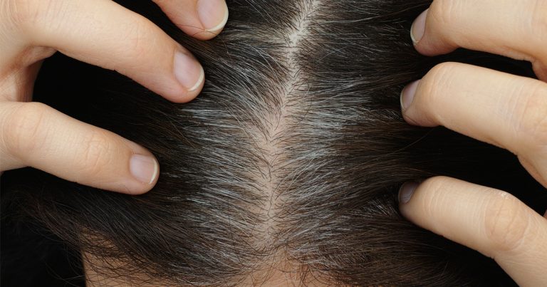 Rambut Beruban Mungkin Bermakna Jantung Kita Bermasalah