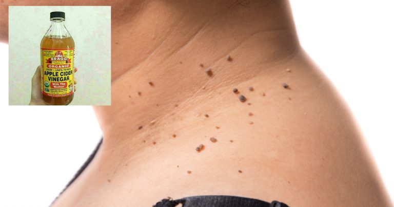 Atasi Masalah Skin Tag Dengan Cuka Epal, Tanggal Sendiri Tanpa Rasa Sakit
