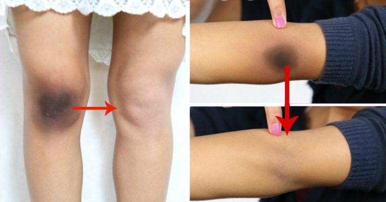 Muka Putih Tapi Siku, Lutut, Ketiak Hitam! 5 Petua Semula Jadi Ini Boleh Cerahkannya Kembali