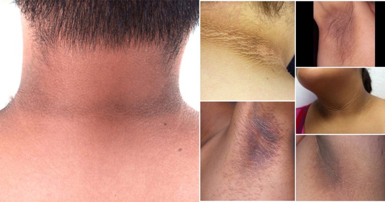 Awas, Kalau Badan Berisi & Ada Kesan Hitam Ini ! Bukan Daki Tapi Petanda Penyakit Bahaya