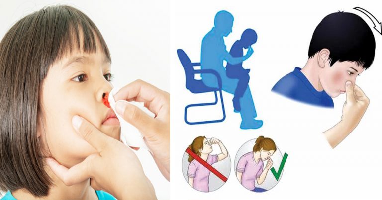 4 Langkah Ibu Bapa Perlu Buat Jika Hidung Anak Berdarah