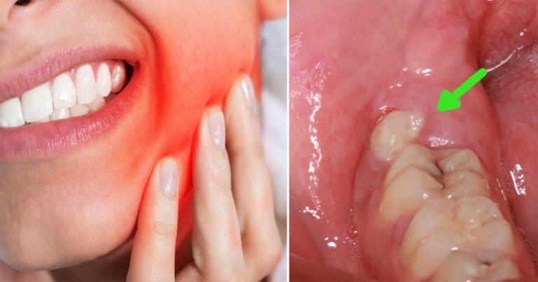Tak Tahan Gigi Geraham Sakit, 5 Bahan Semula Jadi Ini Bantu Redakan Sakit Dengan Segera