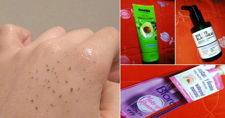 Kalau Wajah Banyak Blackhead, Boleh Cuba 3 Langkah Ini Supaya Kulit Kembali Bersih Flawless