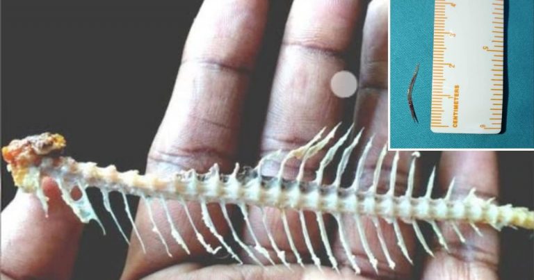 Tercekik Tulang Ketika Makan Ikut Panduan Doktor Ini, Bukan Telan Gumpal Nasi & Pisang