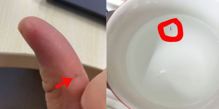 Kalau Jari Tertusuk Duri Atau Selumbar, Rendam Dengan Air Bancuhan Ini. Senang Keluar, Tak Sakit Langsung