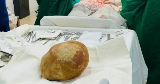 Sukar Kencing Bertahun-Tahun, Doktor Temui Batu 3.1kg Dalam Pundi Kencing Lelaki Ini 4 Sukar Kencing Bertahun-Tahun, Doktor Temui Batu 3.1kg Dalam Pundi Kencing Lelaki Ini