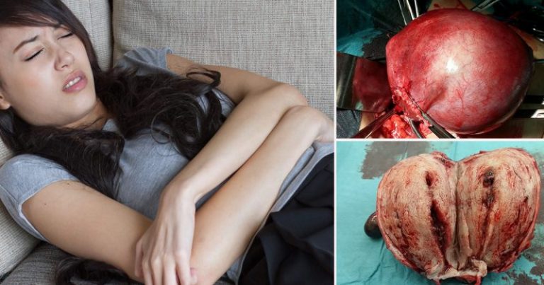 Ketumbuhan Besar Dalam Rahim,  Awas Kalau Mak Pernah Kena. Anak Perempuan Berisiko! Kena Perhati Tanda Ini