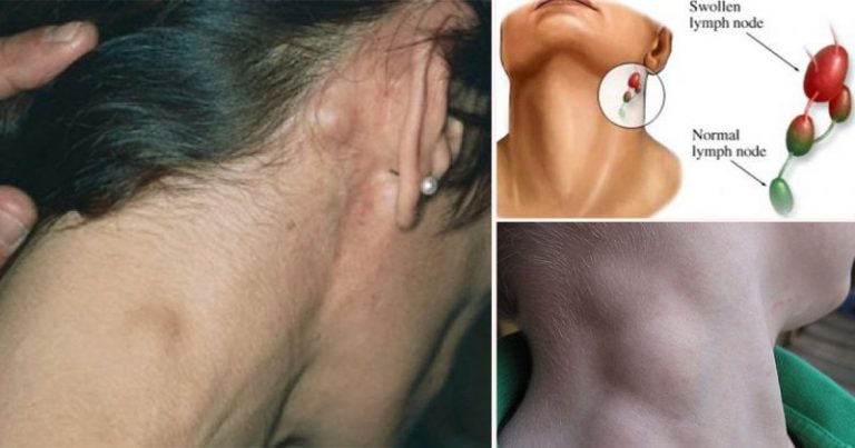 Awas Bengkak Tak Surut Pada Leher, Demam, Letih & Berat Badan Turun! Boleh Jadi Petanda Kanser Limfoma