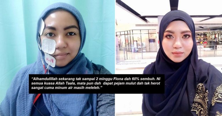 Mulut Herot, Mata Tak Boleh Pejam. Wanita Ini Kongsi Pengalaman Kena Strok Di Usia Muda Hingga Lumpuh Sebelah Muka