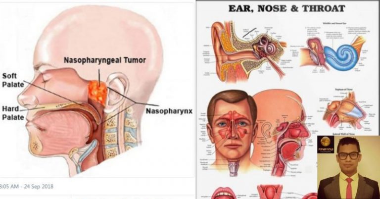 Kanser Pangkal Hidung, Doktor Ini Pesan Peminat Ikan Kering Kena Peka Dengan Gejalanya