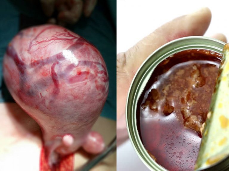 3 Jenis Makanan Kita Biasa Ambil Tapi Sebenarnya Galak Pertumbuhan Fibroid