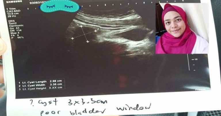Pengalaman Kena Cyst Berulang-kali, Wanita Ini Saran Elak 5 Jenis Makanan Kalau Sayangkan Rahim