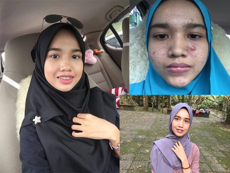 Guna Air Filter Bukan Paip, Hasilnya 4 Bulan Saja Jerawat Serius Dah Pulih