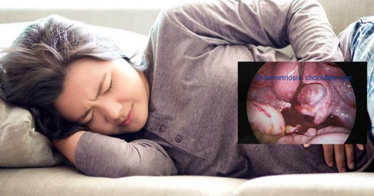 8 Tanda Penyakit Endometriosis Perlu Diawasi Wanita Muda Sebelum Jejas Kesuburan, Rosakkan Peranakan