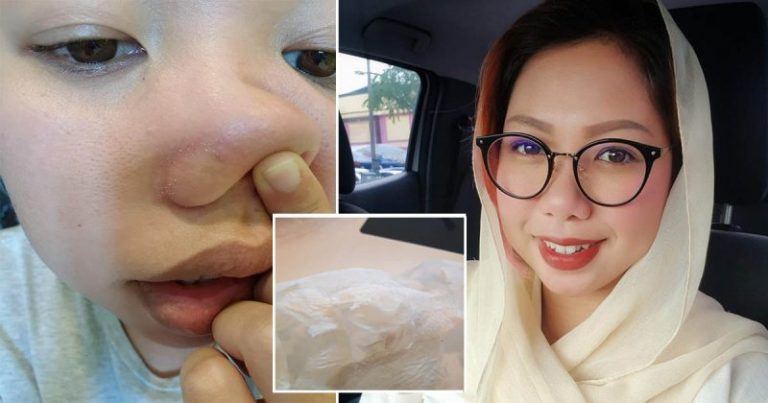 Tak Perlu Treatment Mahal, Ikut Petua Wanita Ini Hilangkan Whitehead & Blackhead Modal Cuma 50 Sen!