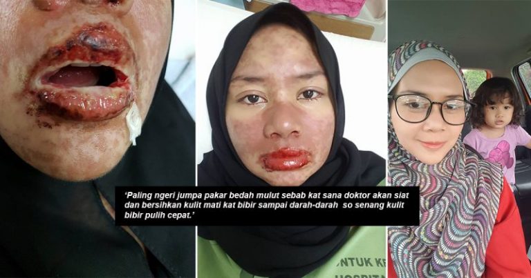 Bermula Dari Sakit Gigi Satu Badan Kemerahan Macam Terbakar, Mulut Penuh Ulser, Bibir Menggelupas. Tak Sangka Ini Yang Dialami Akibat Alahan Ubat!