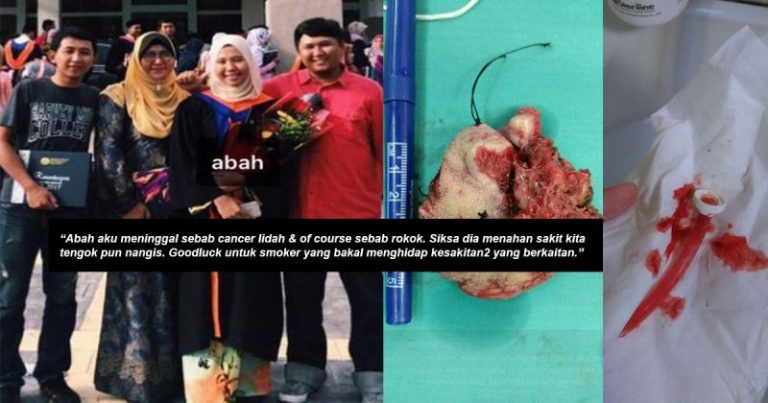 Tak Dapat Makan & Bercakap Selama Setahun Sebab Kanser Lidah. Gadis Ini Kongsi Derita Arwah Ayah Akibat Rokok