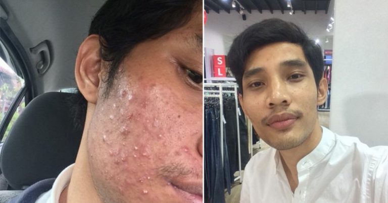 Pernah Nak Gosok Muka Pakai Kertas Pasir, Tapi Wajah Penuh Jerawat Lelaki Ini Kembali Pulih Dengan Modal Hanya RM 7