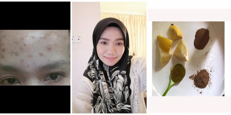 Wanita Ini Kongsi Cara Berkesan Kecutkan Jerawat Tanpa Parut, Guna Masker ‘Berangin’ Dari Kayu Manis & Buah Pala