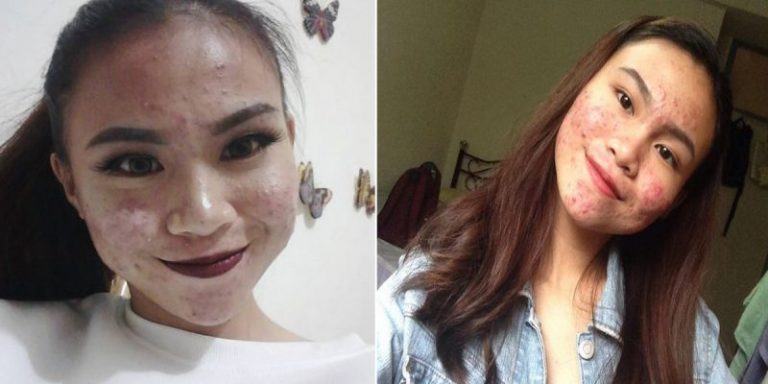 Tak Malu Tayang Wajah Penuh Jerawat Di Instagram, Charisa Ajar Diri Nilai Orang Lain Kerana Hati Bukan Luaran