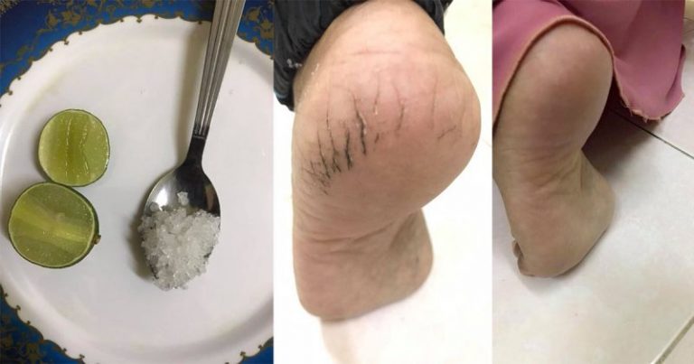 Masalah Tumit Merekah & Hitam ‘Setel’ Dalam Masa 5 Minit, Terus Halus Mulus. Petua Wanita Ini Berbaloi Cuba!