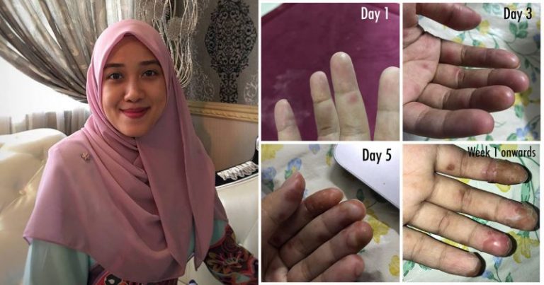 Setiap Bintik Kecil Tu Rasa Tajam Macam Kena Hiris! Ibu Cerita Pengalaman Dijangkiti HFMD Bersama Anak
