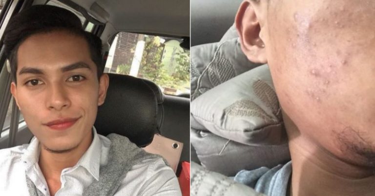 Dulu Berjerawat Teruk, Kulit Lelaki Ini Jadi Cantik Lepas Pakai Pencuci Muka Milik Ibu